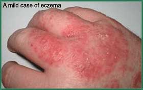 eczema-photo1